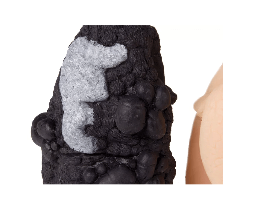 Lungenkrebs - Vergleichsmodell - Erler - Zimmer