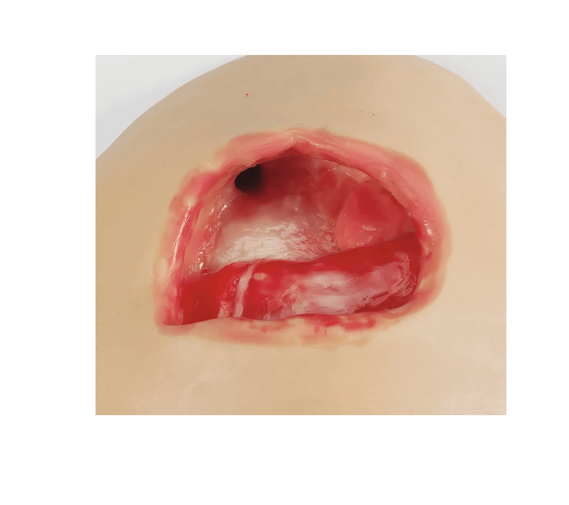 Übungsmodelle für die Vakuum - Wundtherapie - Erler - Zimmer