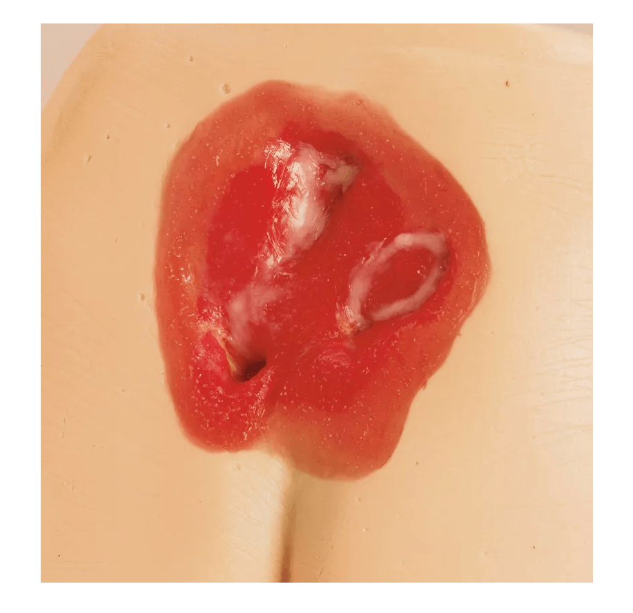 Druckgeschwür / Dekubitus Modelle - Erler - Zimmer