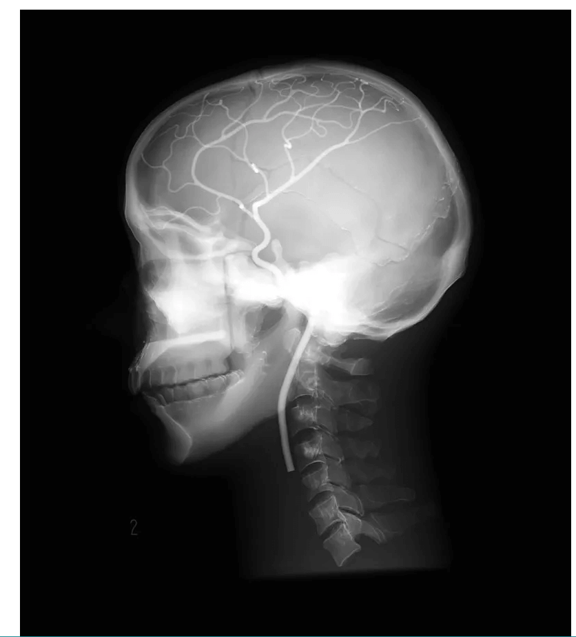 Angiographie Kopfmodell - Erler - Zimmer
