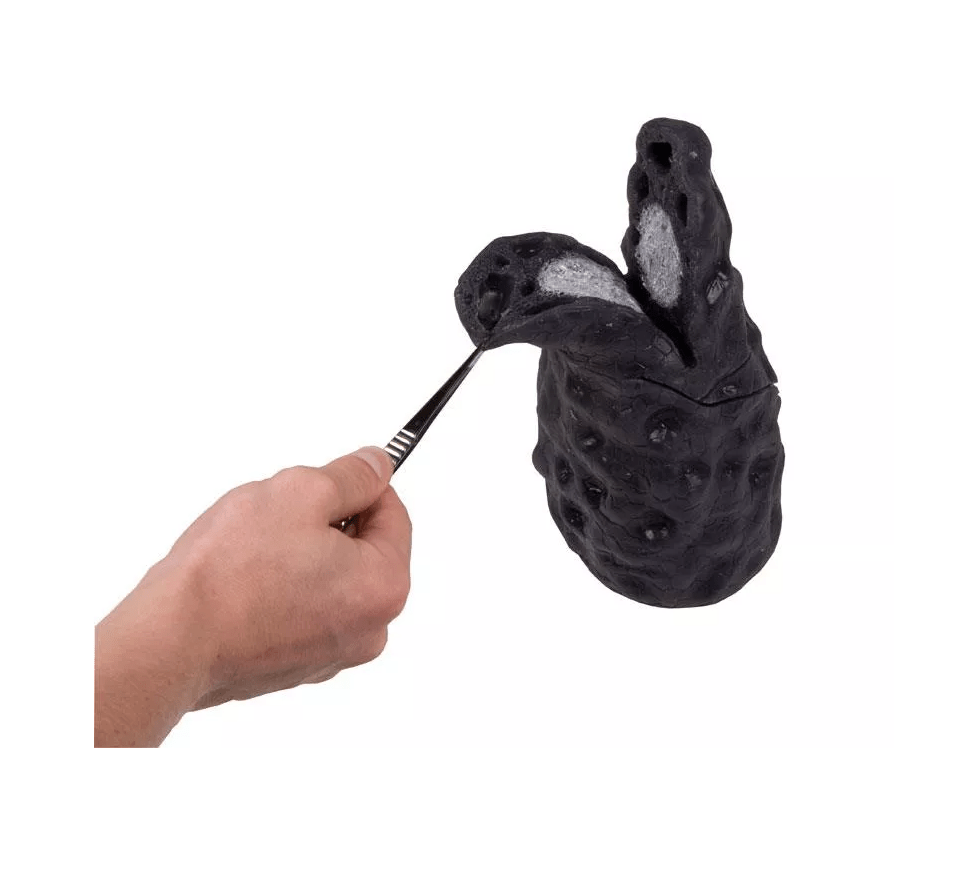 Lungenkrebs - Modell - Erler - Zimmer