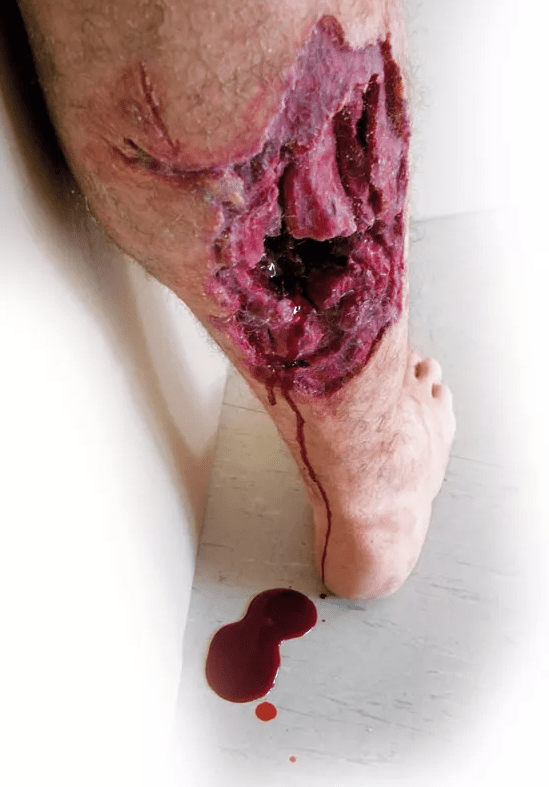 Notfall - Unterschenkel - Erler - Zimmer