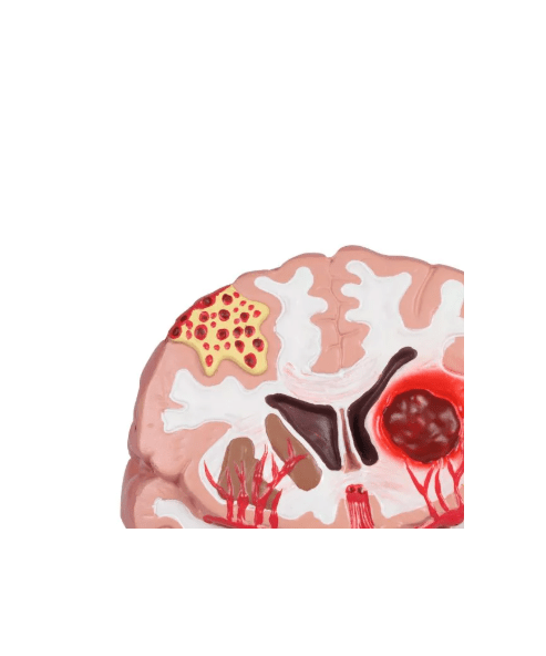 Pathologien des Gehirns, lebensgröße - Erler - Zimmer