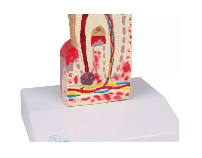 Zahnkariesmodell, 10 - fache Größe - Erler - Zimmer