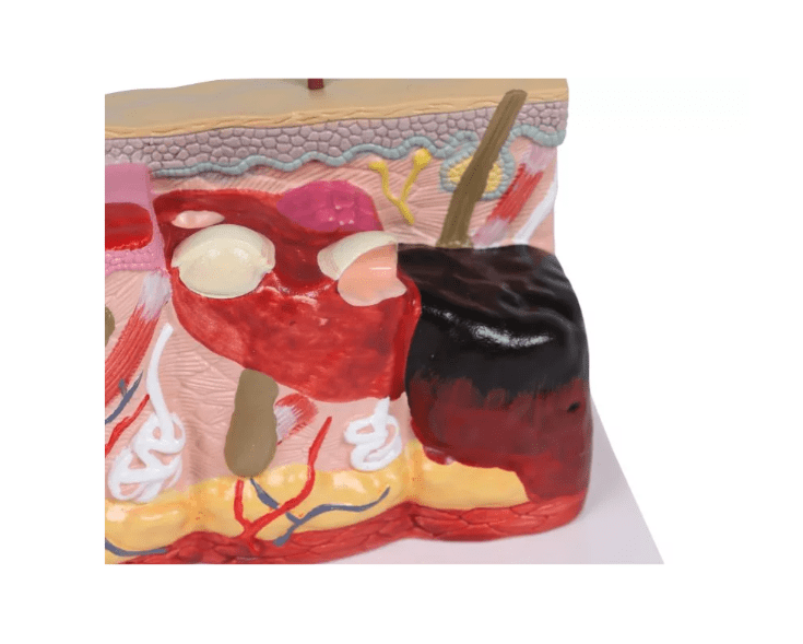 Pathologisches Hautmodel mit Verbrennung, 30 - fache Größe - Erler - Zimmer