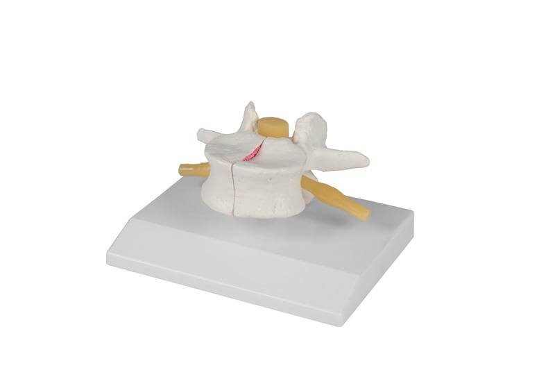 Osteoporose - Wirbel, 2 - fach vergrößert – Vergleich gesunde und osteoporotische Struktur - Erler - Zimmer