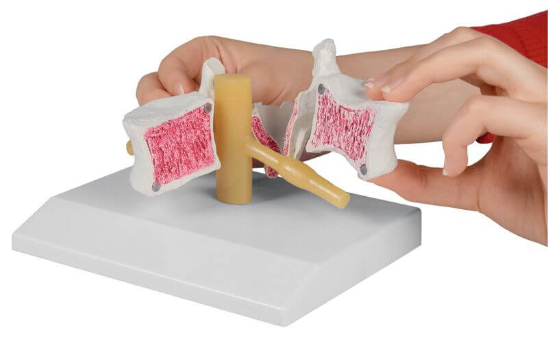 Osteoporose - Wirbel, 2 - fach vergrößert – Vergleich gesunde und osteoporotische Struktur - Erler - Zimmer