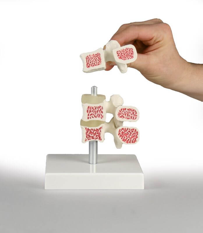 Osteoporose - Wirbel - Modell mit 3 Lendenwirbeln – Vergleich gesunde und krankhafte Knochenstruktur - Erler - Zimmer