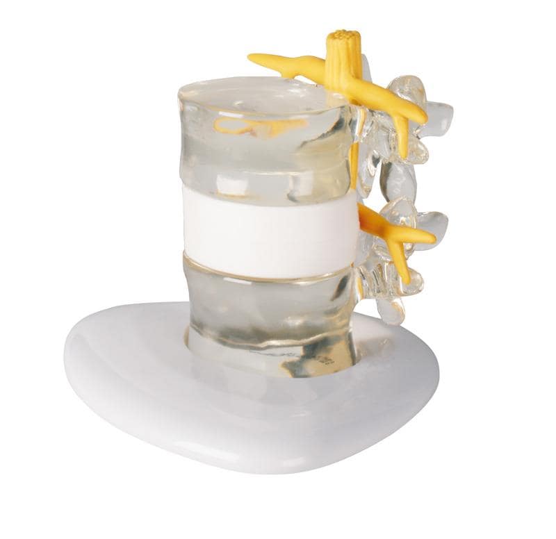 Bandscheiben - Vorfall - Simulator – vergrößertes Demonstrationsmodell für die Patientenaufklärung - Erler - Zimmer