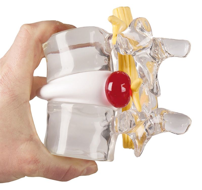 Bandscheiben - Vorfall - Simulator – vergrößertes Demonstrationsmodell für die Patientenaufklärung - Erler - Zimmer