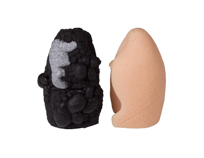 Lungenkrebs - Vergleichsmodell - Erler - Zimmer