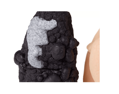 Lungenkrebs - Vergleichsmodell - Erler - Zimmer