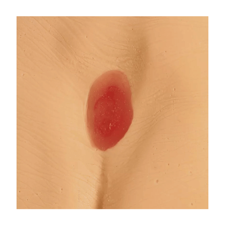 Druckgeschwür / Dekubitus Modelle - Erler - Zimmer