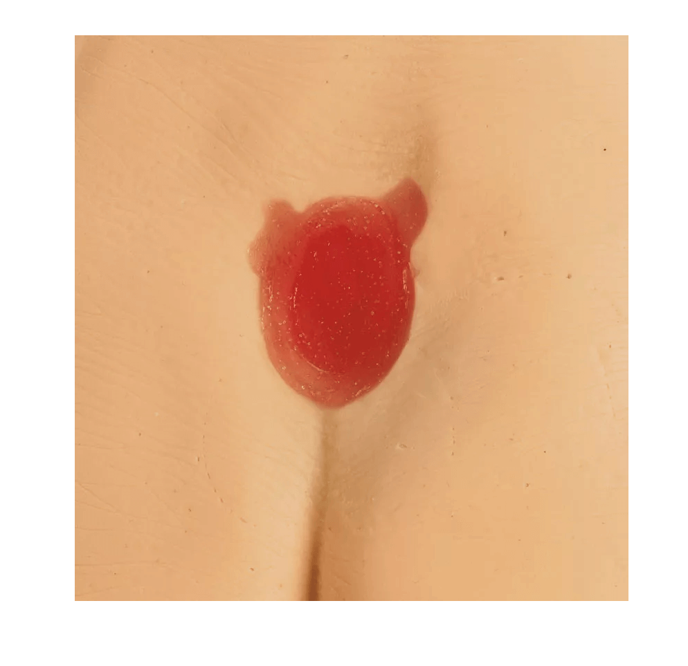 Druckgeschwür / Dekubitus Modelle - Erler - Zimmer