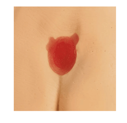 Druckgeschwür / Dekubitus Modelle - Erler - Zimmer