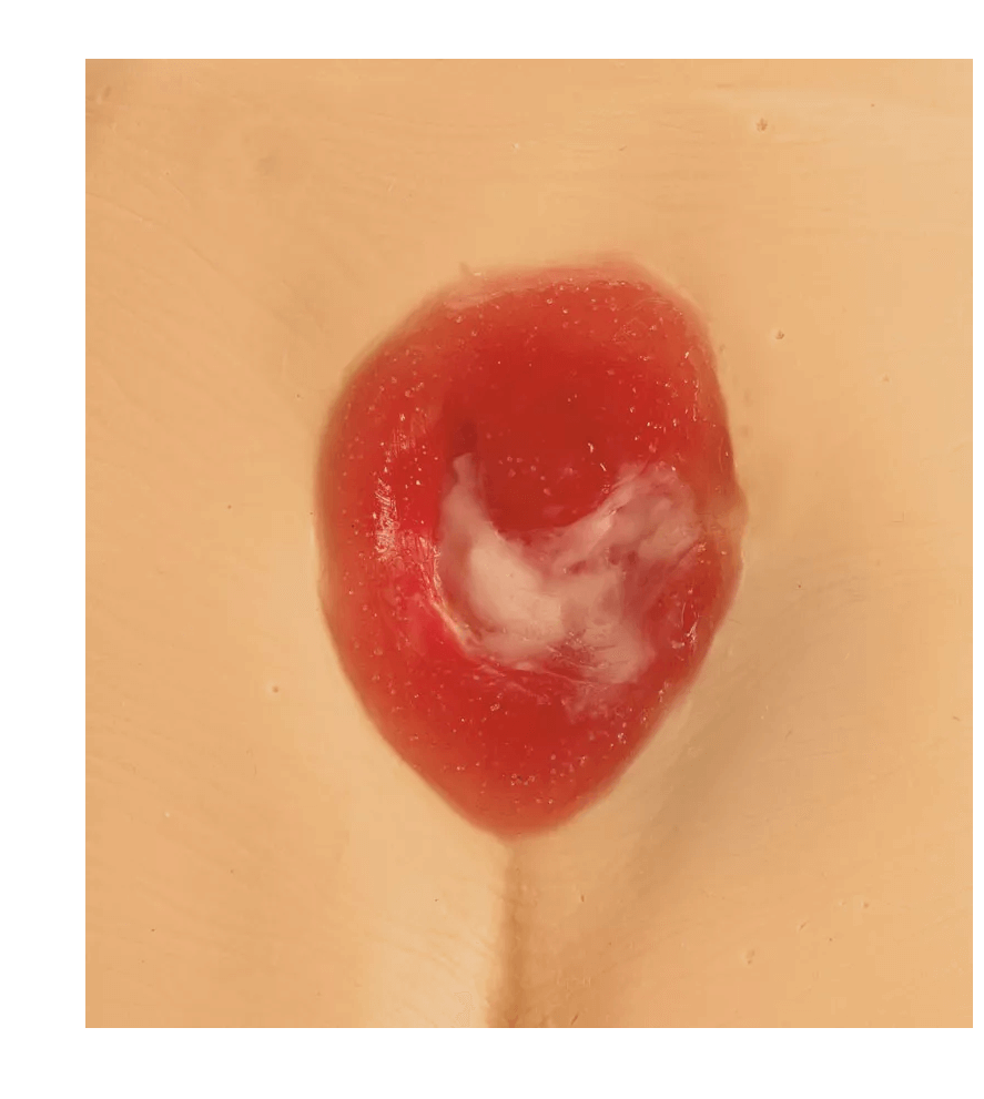 Druckgeschwür / Dekubitus Modelle - Erler - Zimmer