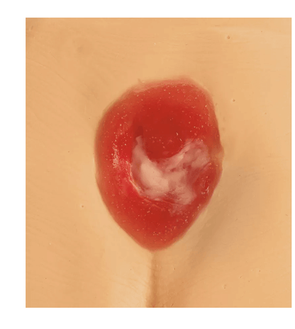 Druckgeschwür / Dekubitus Modelle - Erler - Zimmer