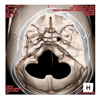 Angiographie Kopfmodell - Erler - Zimmer