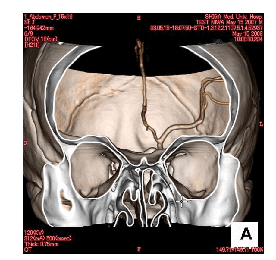Angiographie Kopfmodell - Erler - Zimmer