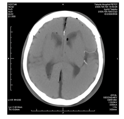 Angiographie Kopfmodell - Erler - Zimmer