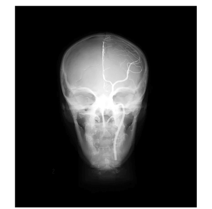 Angiographie Kopfmodell - Erler - Zimmer