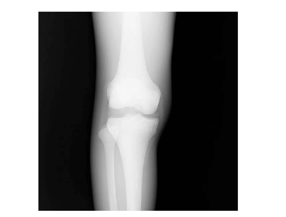 CT Knie Bänder Phantom - Erler - Zimmer