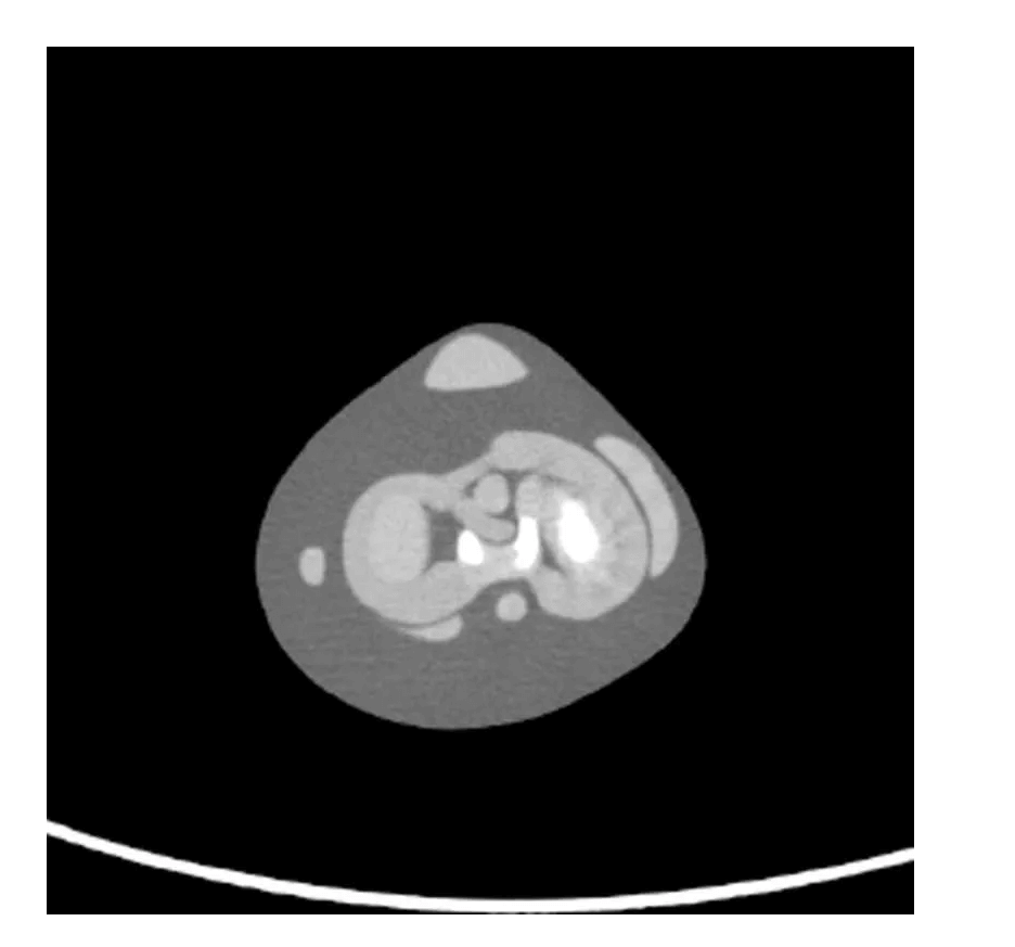 CT Knie Bänder Phantom - Erler - Zimmer