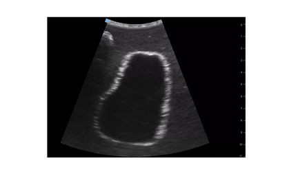 SonoEZ Ultraschalltrainer "Harnblase" - Erler - Zimmer