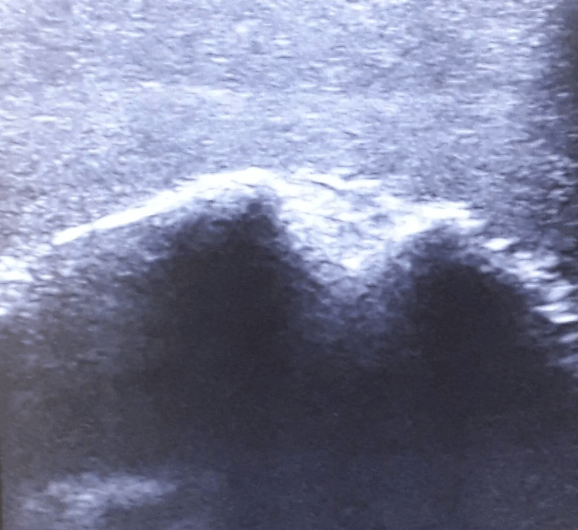 Ultraschall – Übungsmodell Schulter - Erler - Zimmer