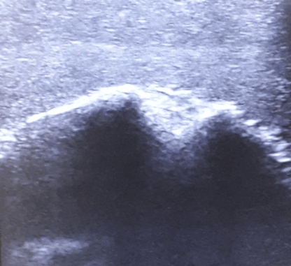 Ultraschall – Übungsmodell Schulter - Erler - Zimmer