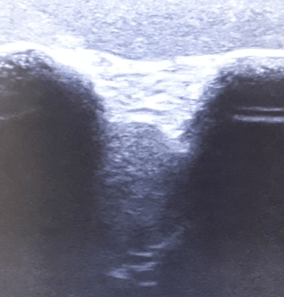 Ultraschall – Übungsmodell Schulter - Erler - Zimmer