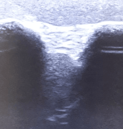 Ultraschall – Übungsmodell Schulter - Erler - Zimmer