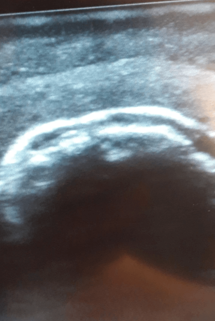 Ultraschall – Übungsmodell Schulter - Erler - Zimmer