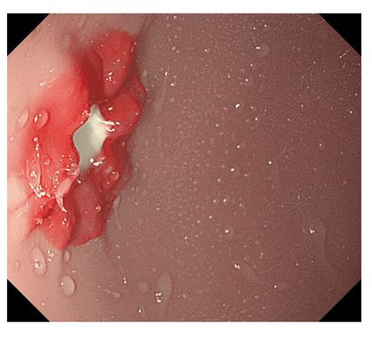 OGD - (Oesophago - Gastro - Duodenoskopie - )Simulator - Erler - Zimmer