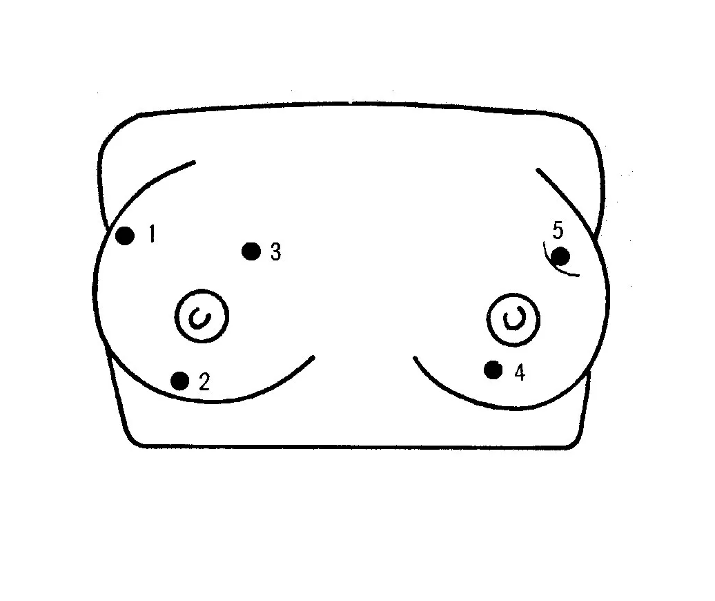 Brustkrebs - Tastmodell - Erler - Zimmer