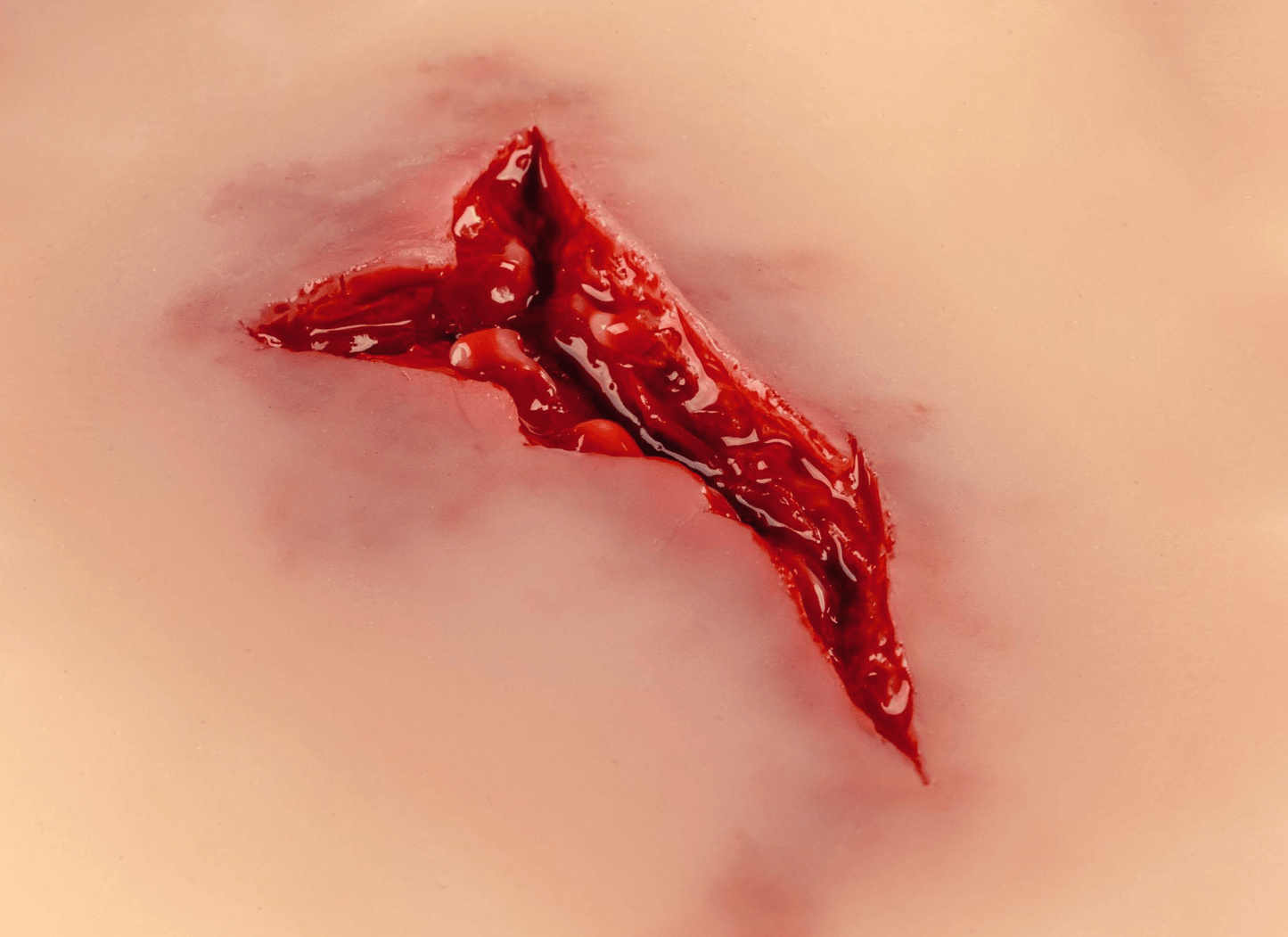 Wundmoulage Risswunde - Erler - Zimmer