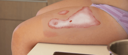 Wundmoulage Verbrühung - Erler - Zimmer