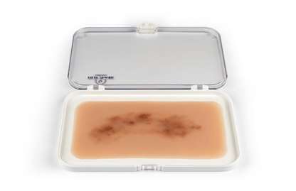 Wundmoulage Hämatom frisch - Erler - Zimmer