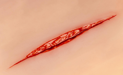 Wundmoulage Suizidversuch - Erler - Zimmer