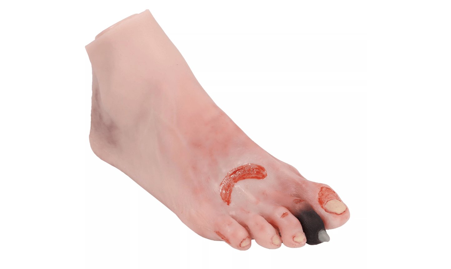 Wundenfuß mit diabetischem Fußsyndrom, fortg. Stadium, Puppenversion - Erler - Zimmer