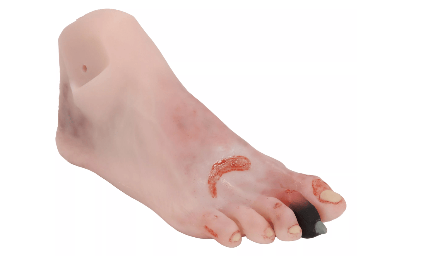 Wundenfuß mit diabetischem Fußsyndrom, fortg. Stadium, für Nursing Anne - Erler - Zimmer