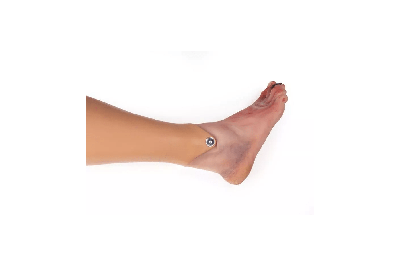 Wundenfuß mit diabetischem Fußsyndrom, fortg. Stadium, für Nursing Anne - Erler - Zimmer