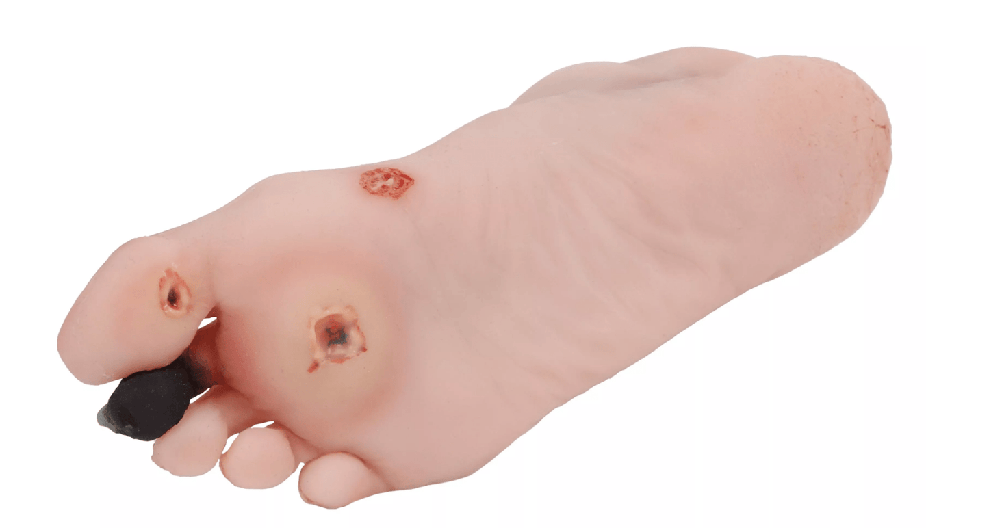 Wundenfuß mit diabetischem Fußsyndrom, fortg. Stadium, für Nursing Anne - Erler - Zimmer