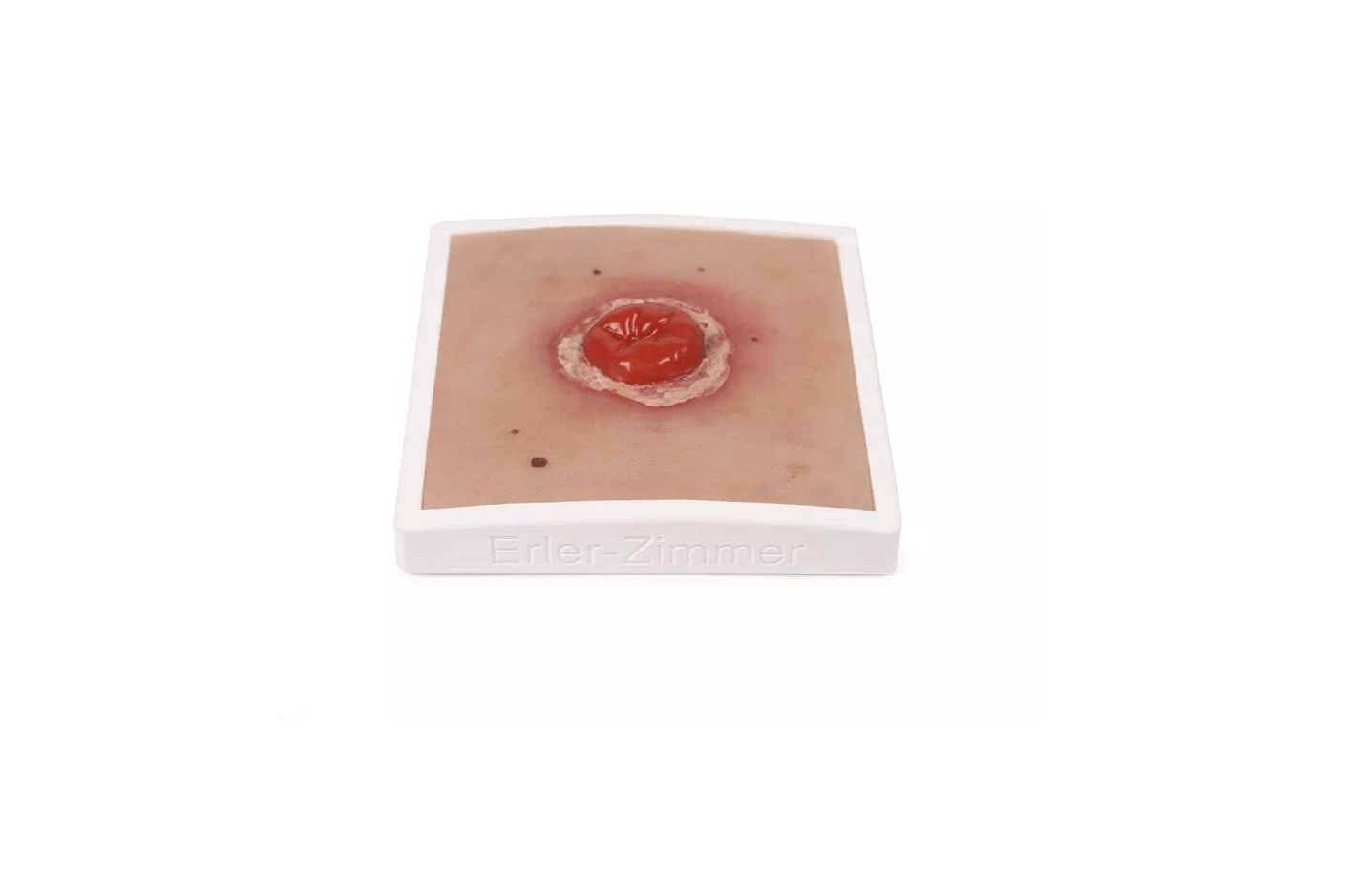 Wundmoulage Kolostoma entzündet, inkl. Stativ - Erler - Zimmer