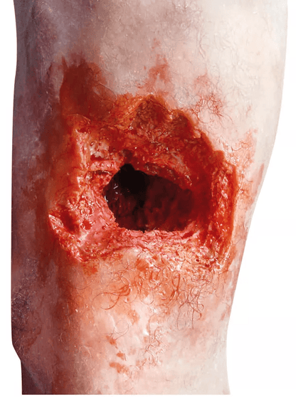 Notfallbein - Erler - Zimmer