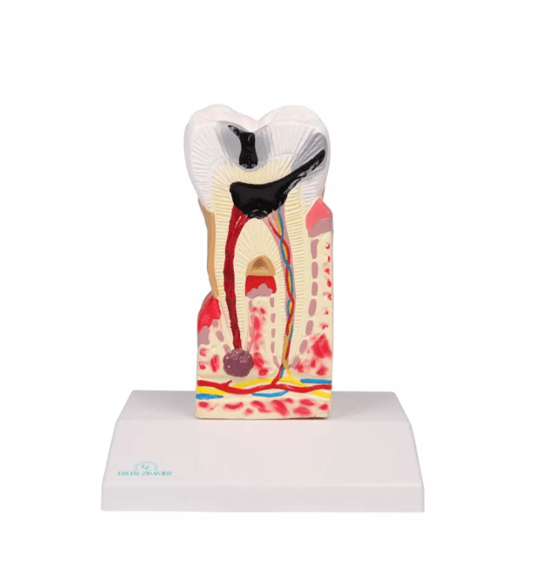 Zahnkariesmodell, 10 - fache Größe - Erler - Zimmer