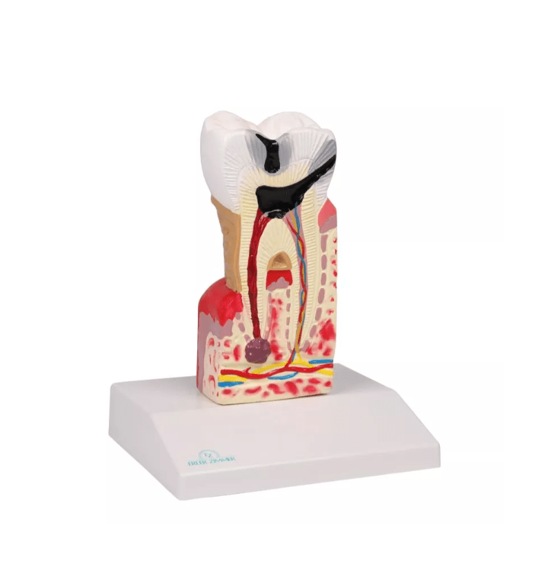 Zahnkariesmodell, 10 - fache Größe - Erler - Zimmer
