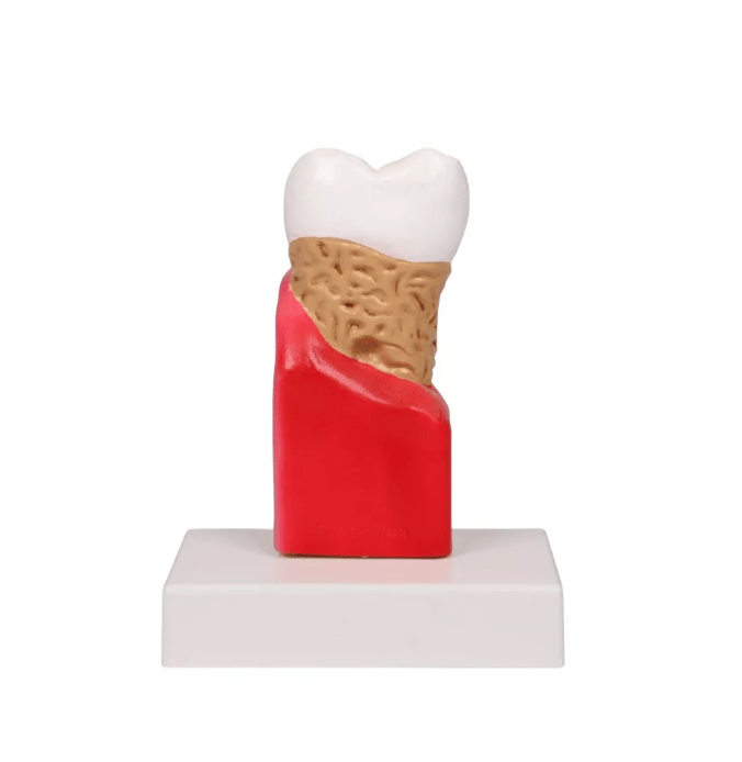 Zahnkariesmodell, 10 - fache Größe - Erler - Zimmer