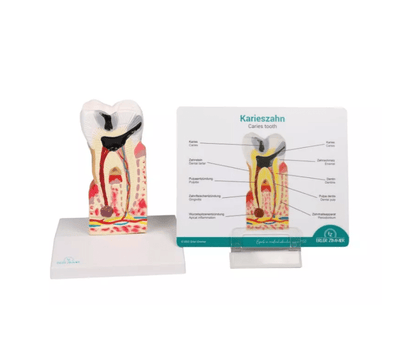 Zahnkariesmodell, 10 - fache Größe - Erler - Zimmer