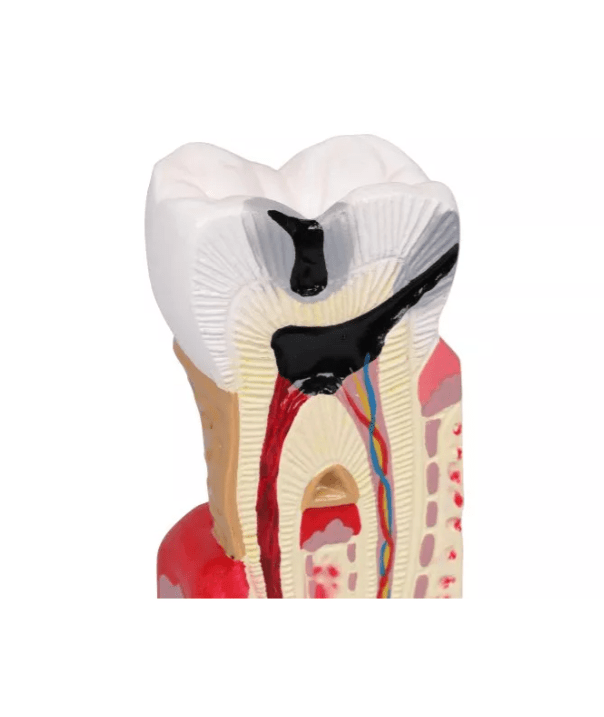 Zahnkariesmodell, 10 - fache Größe - Erler - Zimmer